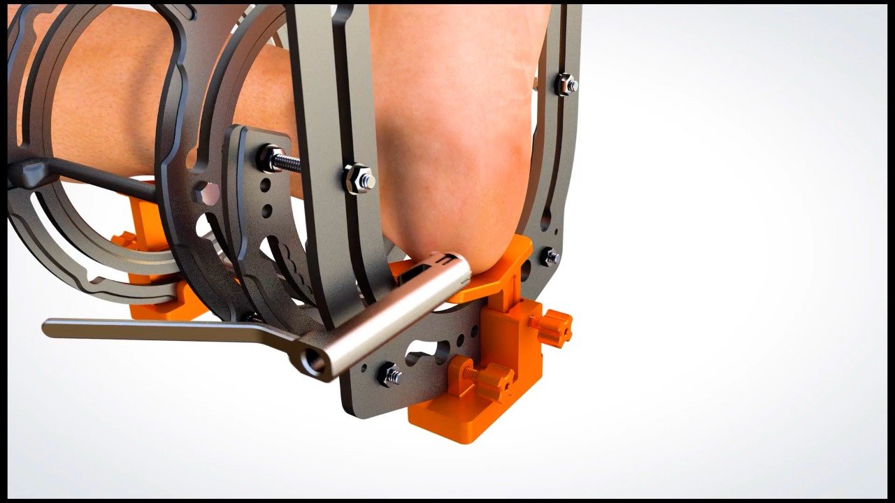 Frame from Foot surgery procedure